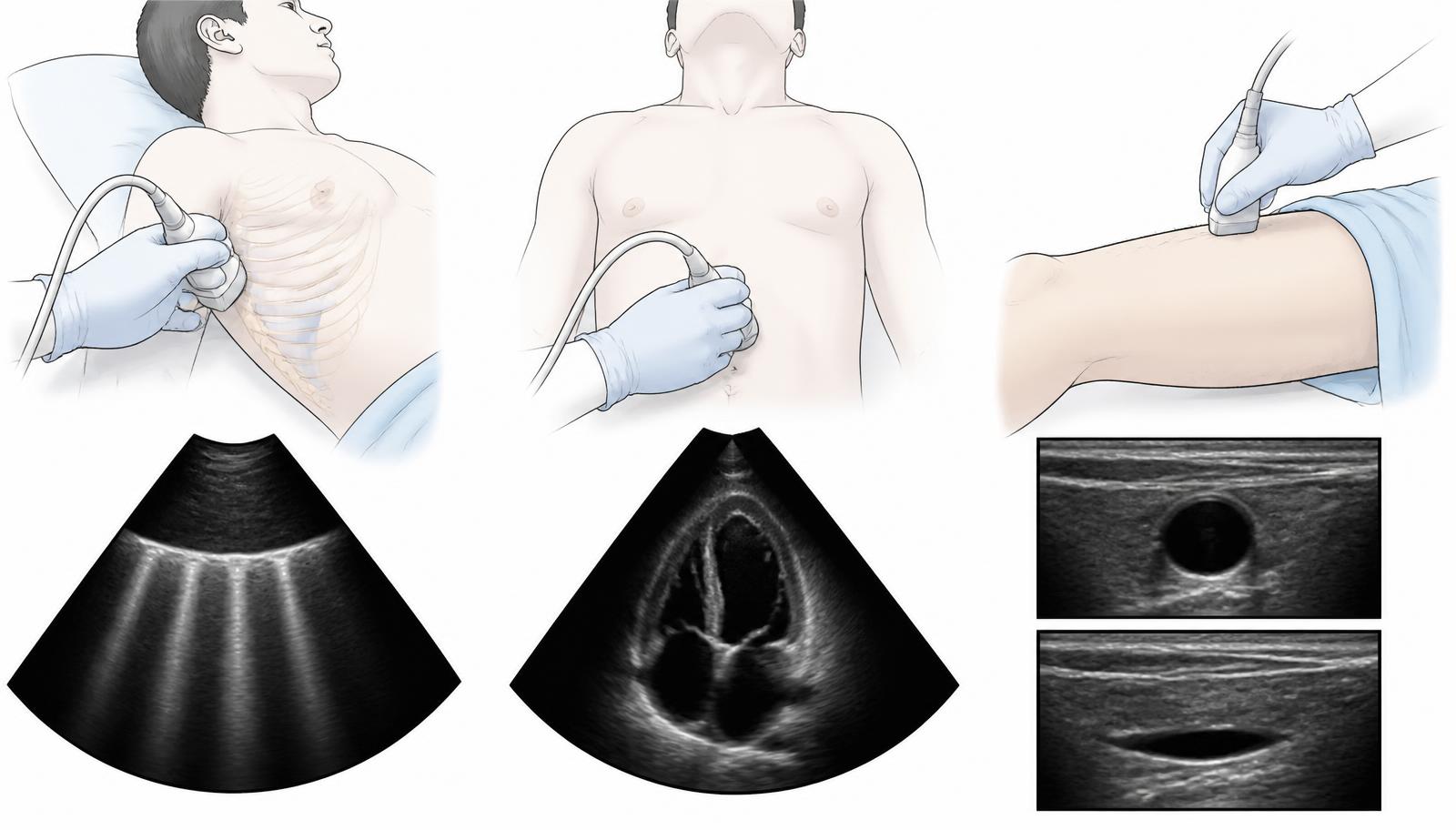 Ilustrações de ultrassonografia pulmonar, cardíaca focada e compressão venosa